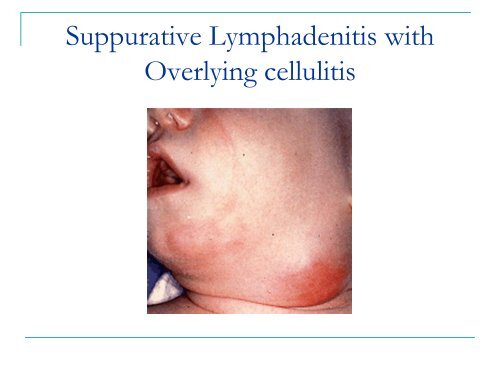 Reactive Lymphadenitis âAcute & Chronicâ