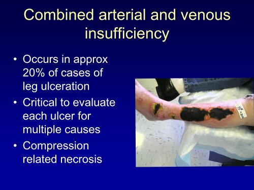 Topical Management of arterial and venous ulcers - VascularWeb