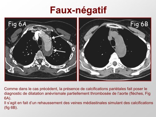 Dissection aortique: aspects atypiques et piÃ¨ges diagnostiques