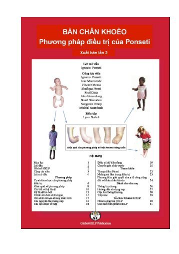 Clubfoot: Ponseti Management [Vietnamese] - Global HELP