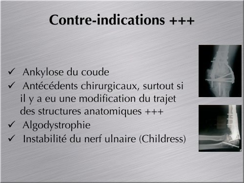 L'arthroscopie du coude: Technique et diagnostic ... - ClubOrtho.fr