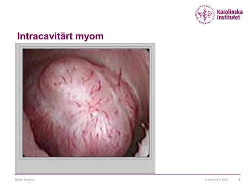 Mifepristone som preoperativ myombehandling - SFOG