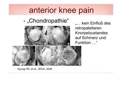 Der sekundÃ¤re Patellaersatz - Vinzenz Gruppe