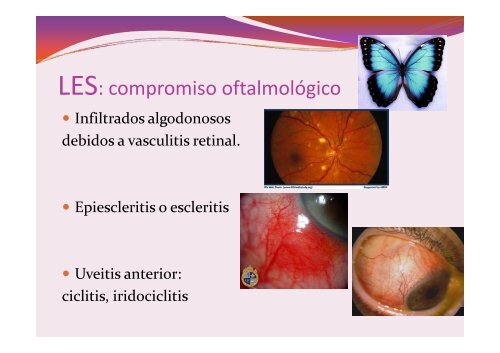 LUPUS ERITEMATOSO SISTEMICO