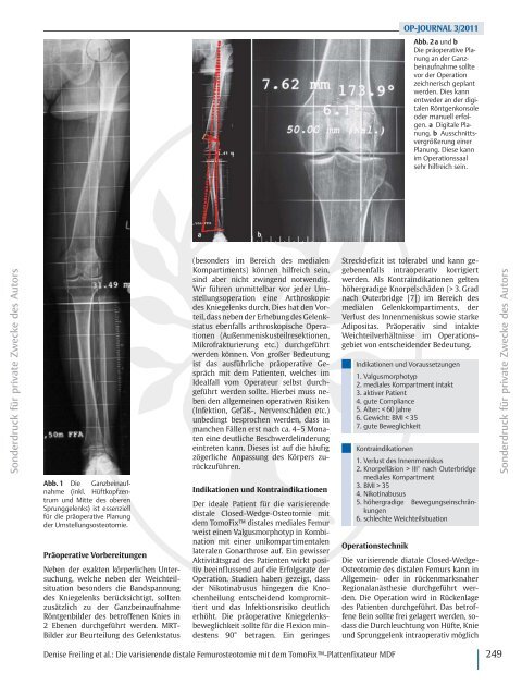 Osteotomie am Femur - sportsclinic Germany