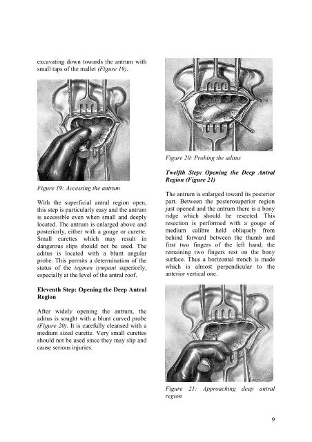 Hammer and gouge mastoidectomy for acute mastoiditis - Vula ...