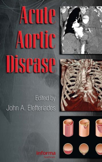 Acute Aortic Disease.. - Index of