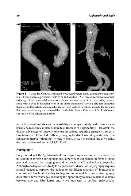 Acute Aortic Disease.. - Index of