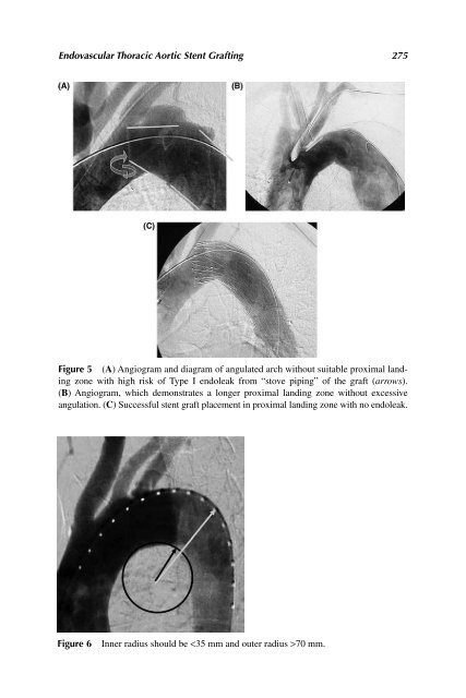 Acute Aortic Disease.. - Index of