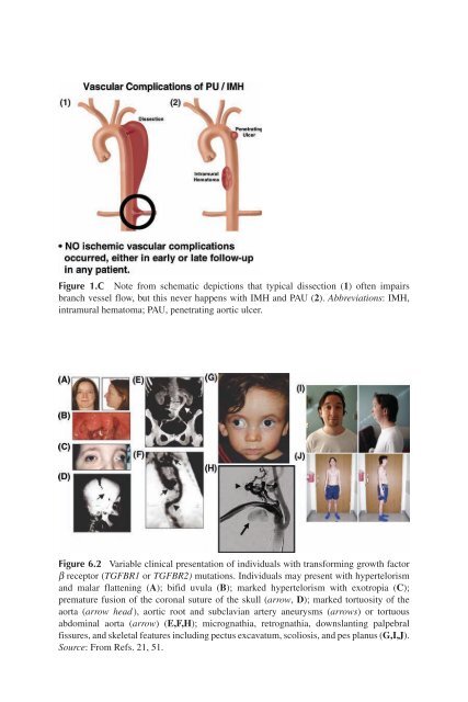 Acute Aortic Disease.. - Index of