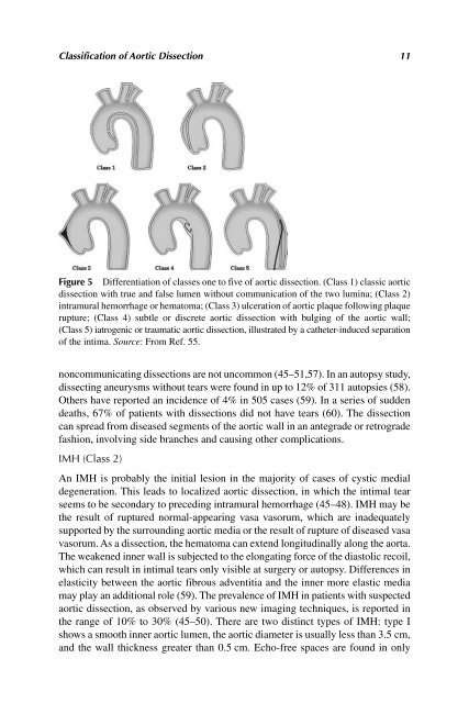 Acute Aortic Disease.. - Index of