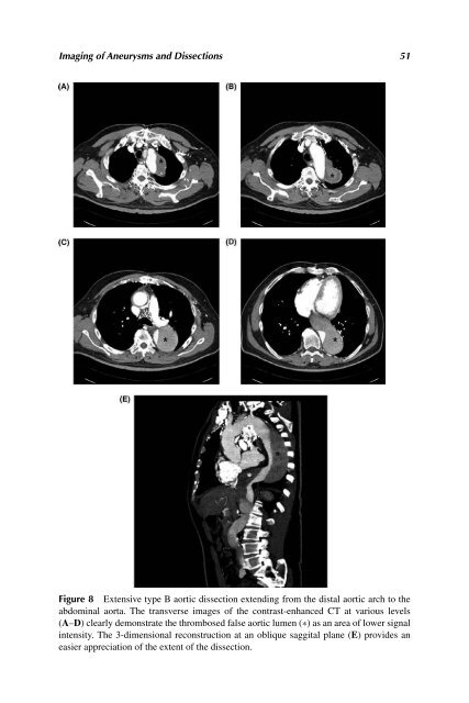 Acute Aortic Disease.. - Index of