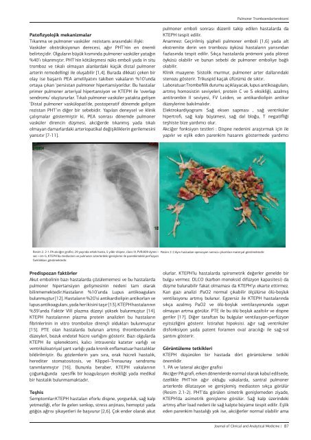 Pulmoner Tromboendarterektomi - jcam.com.tr