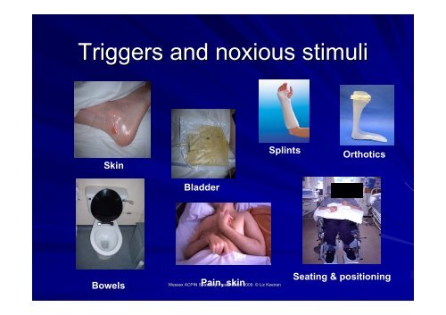 Spasticity Management: Long term follow up- a team ... - acpin