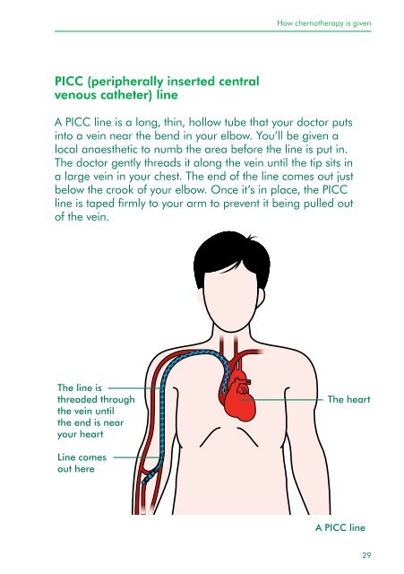 Understanding chemotherapy - Macmillan Cancer