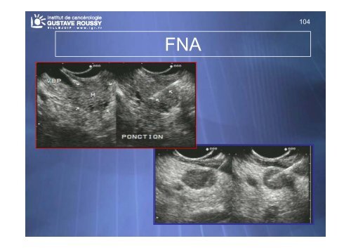 Echo-endoscopie : Particularités et indications