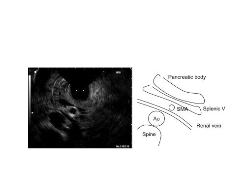 Echo-endoscopie : Particularités et indications