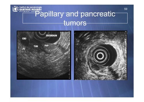 Echo-endoscopie : Particularités et indications