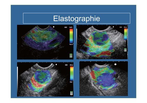 Echo-endoscopie : Particularités et indications