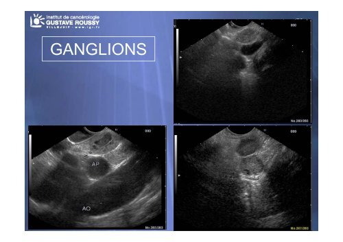 Echo-endoscopie : Particularités et indications