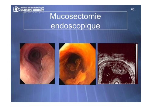 Echo-endoscopie : Particularités et indications