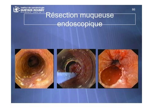 Echo-endoscopie : Particularités et indications