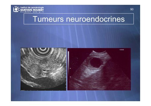 Echo-endoscopie : Particularités et indications