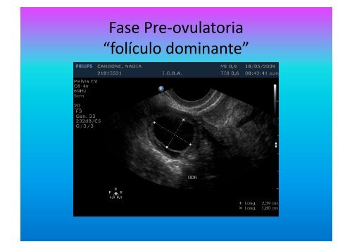 UltrasonograMa en Ginecología - IGBA