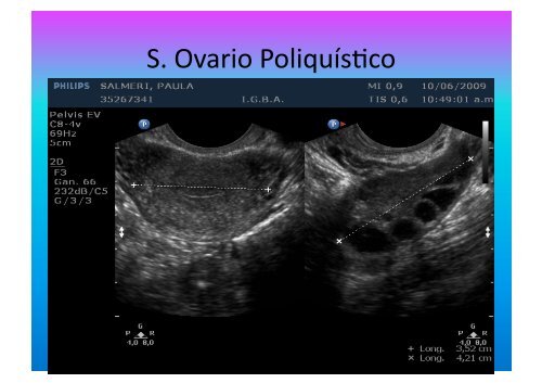 UltrasonograMa en Ginecología - IGBA