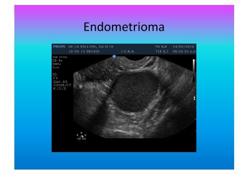 UltrasonograMa en Ginecología - IGBA