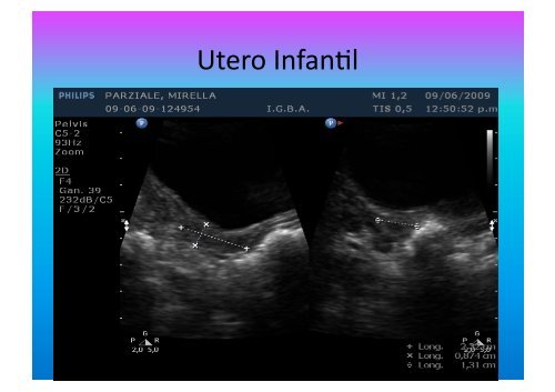 UltrasonograMa en Ginecología - IGBA