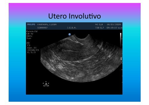 UltrasonograMa en Ginecología - IGBA