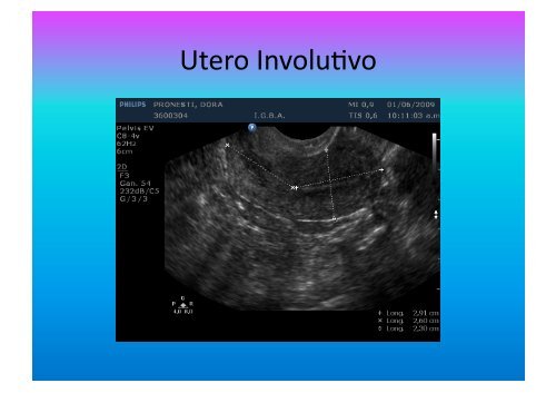 UltrasonograMa en Ginecología - IGBA