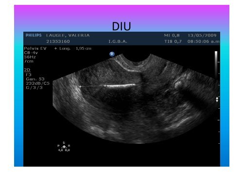 UltrasonograMa en Ginecología - IGBA