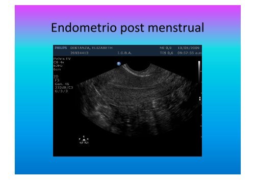 UltrasonograMa en Ginecología - IGBA