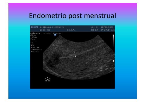 UltrasonograMa en Ginecología - IGBA