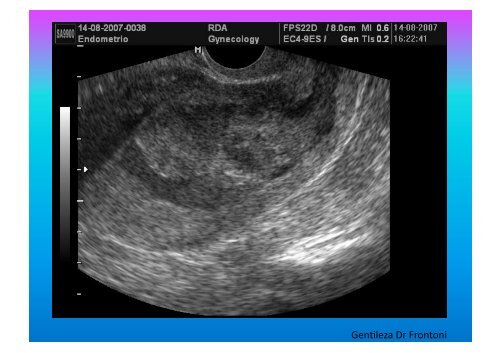 UltrasonograMa en Ginecología - IGBA