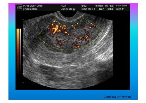 UltrasonograMa en Ginecología - IGBA