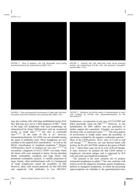 ANAPLASTIC KI-1 (CD30) POSITIVE LARGE CELL LYMPHOMA OF ...