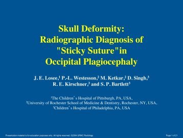 Skull Deformity: ! Radiographic Diagnosis of ! "Sticky Suture"in ...