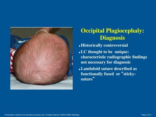 Skull Deformity: ! Radiographic Diagnosis of ! "Sticky Suture"in ...