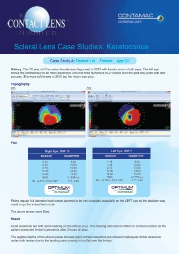 Scleral Lens Case Studies: Keratoconus - Contamac