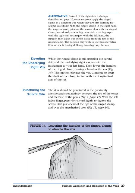 No-Scalpel Vasectomy: An Illustrated Guide for ... - EngenderHealth