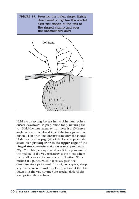 No-Scalpel Vasectomy: An Illustrated Guide for ... - EngenderHealth