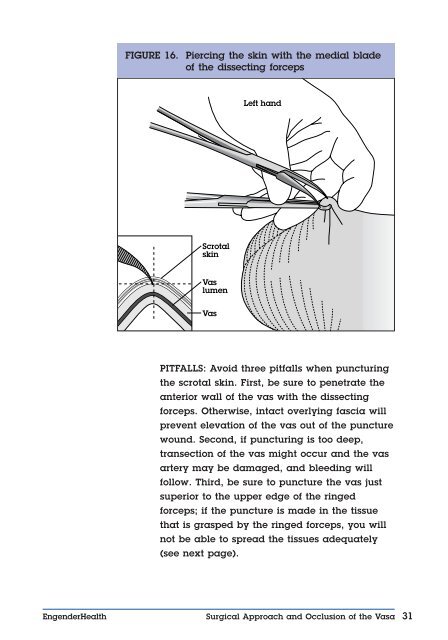 No-Scalpel Vasectomy: An Illustrated Guide for ... - EngenderHealth