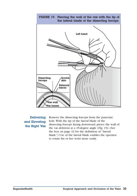 No-Scalpel Vasectomy: An Illustrated Guide for ... - EngenderHealth