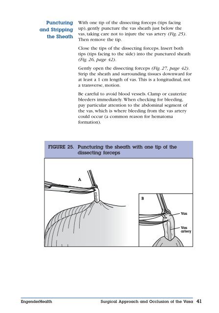 No-Scalpel Vasectomy: An Illustrated Guide for ... - EngenderHealth