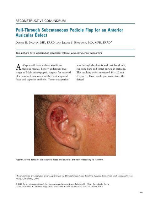 PullThrough Subcutaneous Pedicle Flap for an Anterior Auricular ...