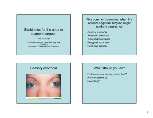 Strabismus For The Anterior Segment Surgeon Sensory Exotropia