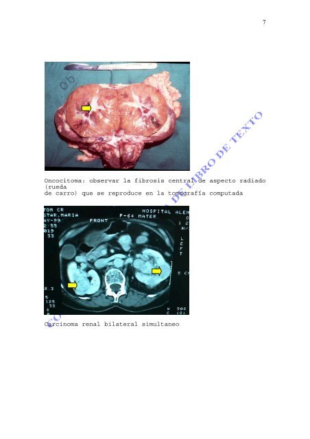 TUMOR RENAL.pdf - FMV